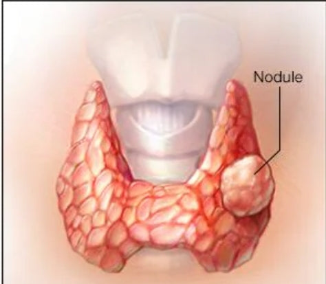 Thyroid Nodule ( Cysts)